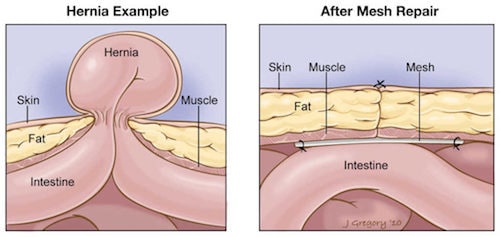 hernia