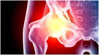 Stryker Femoral Stem